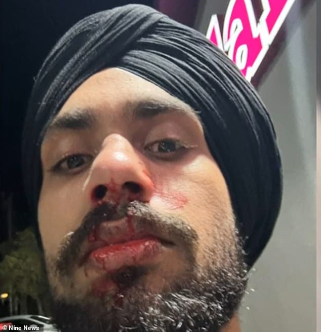 Mr Singh fears that he will need surgery for his broken nose