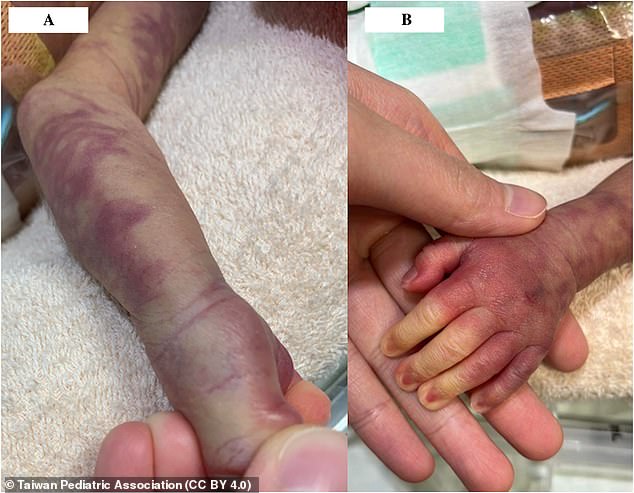Images of a rash or skin discolouration suffered by a baby in Taiwan. This new research, published last October, contradicts Dr Lee's claims, experts say