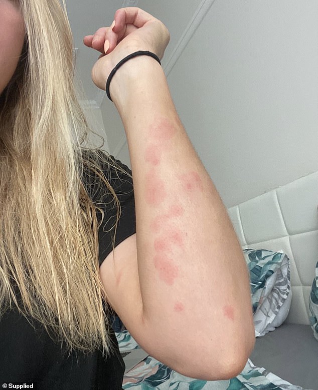 Another tenant initially passed the bedbug marks off as eczema, which she suffers from, however the bites (pictured) continued to appear