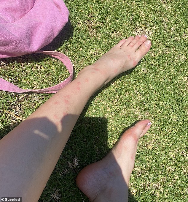 She began experiencing bites on her legs too, however her partner wasn't bitten