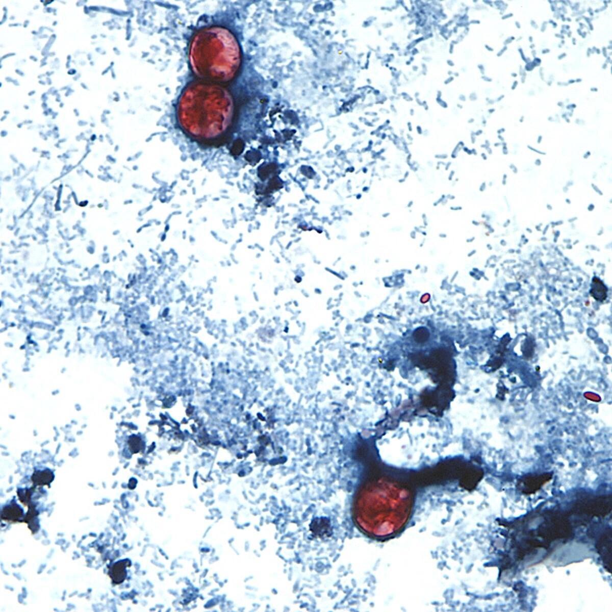 Disease Caused By Cyclospora Parasite Now In 45 States: CDC