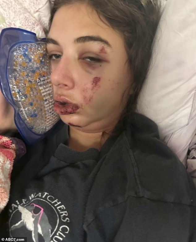 Girl, 14, suffered awful facial injuries after deciding to take friend's e-bike for a spin