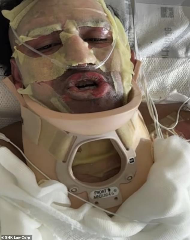Navy swimmer suffers horrific and excruciating burns in devastating 'flame jetting' accident while using popular Amazon product