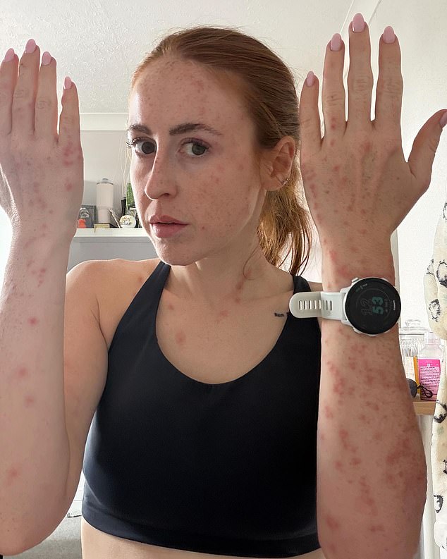 Travelodge guest wakes up with more than 100 bed bug bites after one night in the hotel