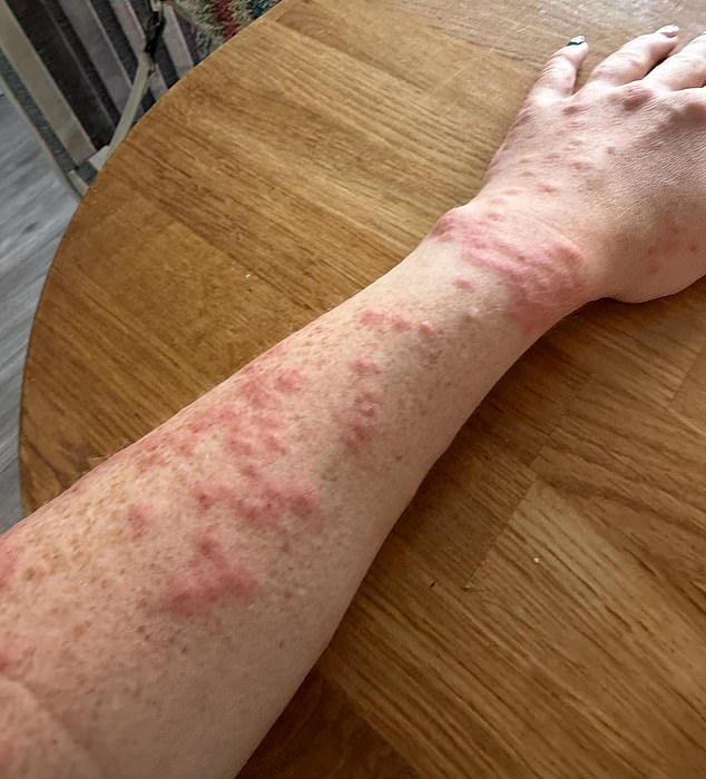 After staying one night in the hotel she said she had been left with more than 100 bites