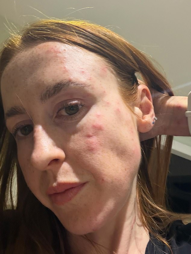 Ms Stephenson said she was left self-conscious and has stayed away from social events because of the bites