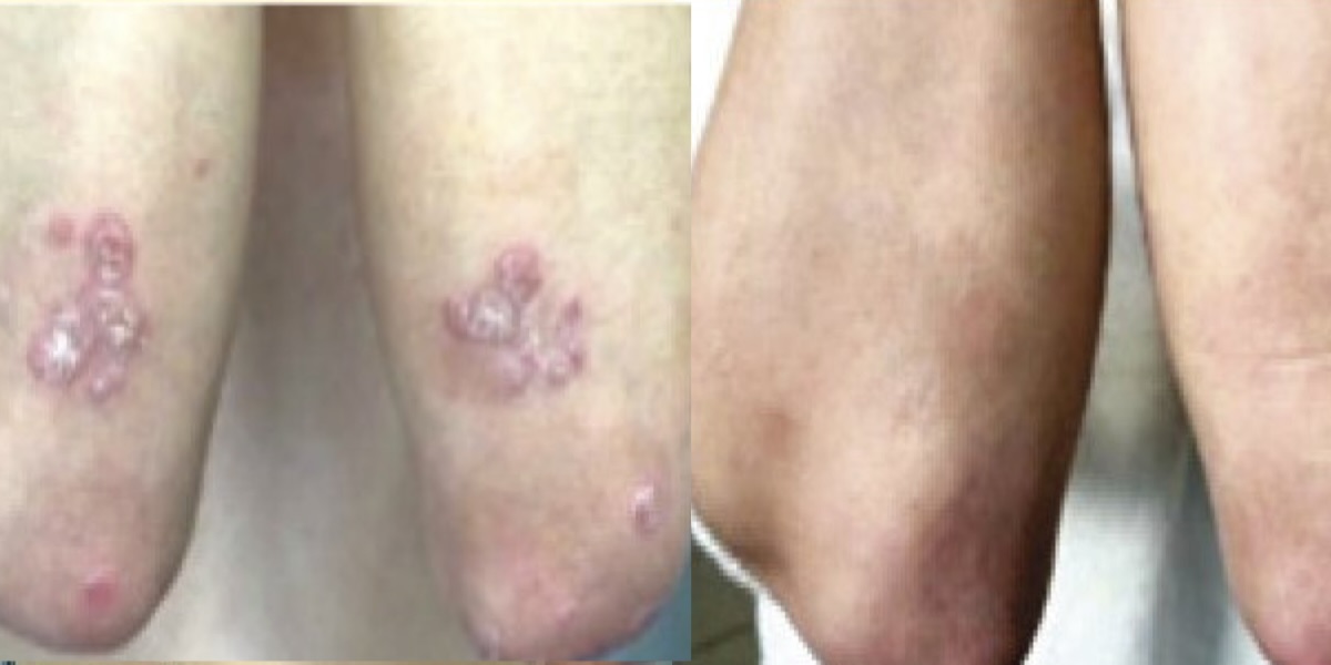 B-Vitamin Supplement Can Treat Psoriasis, a Skin Condition with No Cure 